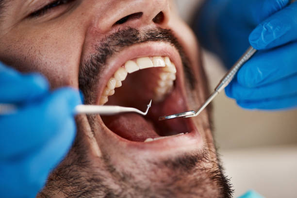 Best Knocked-Out Tooth (Avulsed Tooth) Treatment in Elkader, IA